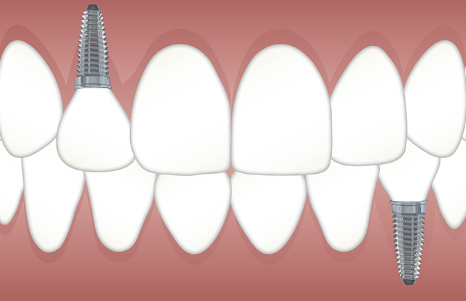 牙齿种植过程有哪些